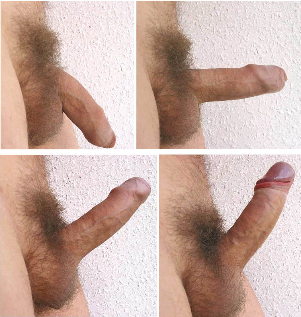 Does Anyone Know What These Bumps Are On The Shaft Of My Penis